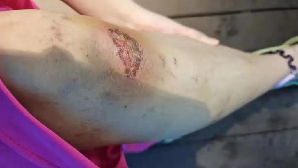 “美人鱼”女孩溺水进了ICU，危险的青春饭  第10张